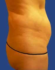 Abdomen Liposuction