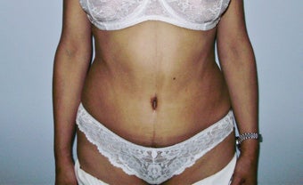 Abdominoplasty