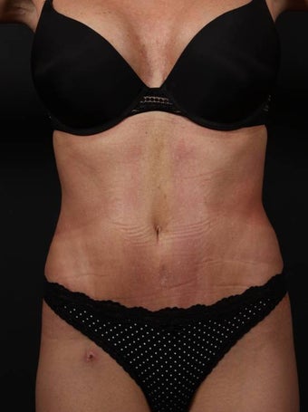 Full tummy tuck revision