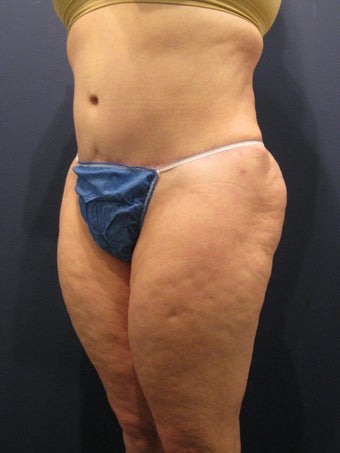 Abdominoplasty