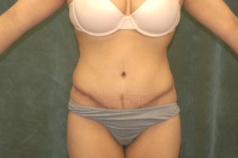 Women's Tummy Tuck Revision 