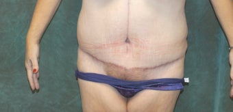 Women's Tummy Tuck Revision 
