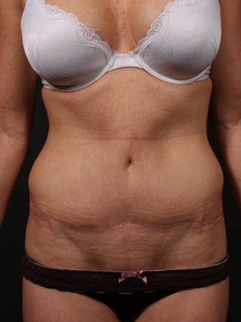 Full tummy tuck revision