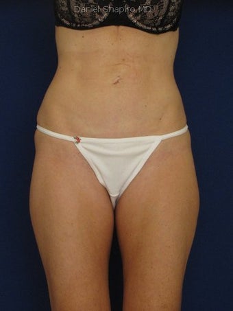 Tummy Tuck Revision with Vaser Liposuction of the abdomen