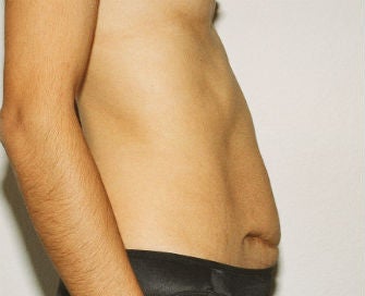 Abdominoplasty Revision