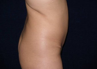 Tummy Tuck Revision