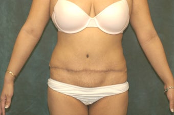 Women's Tummy Tuck Revision 