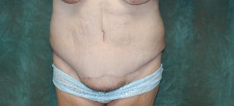 Women's Tummy Tuck Revision 