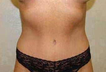 Tummy Tuck