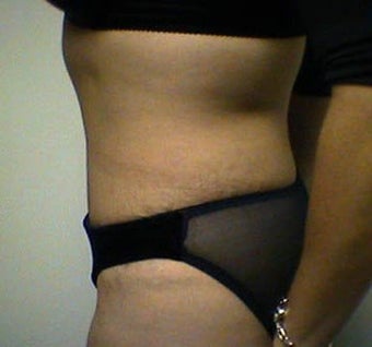 Tummy Tuck