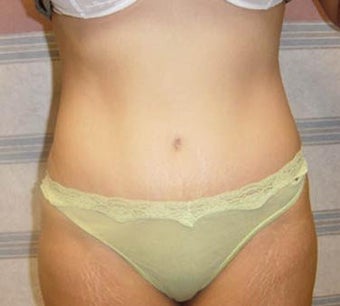 Tummy Tuck