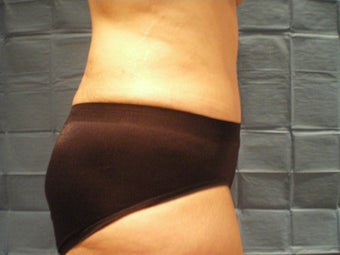 Tummy Tuck