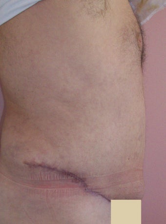 Tummy Tuck before and after