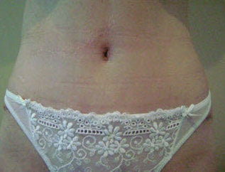 Tummy Tuck