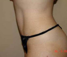 Tummy tuck