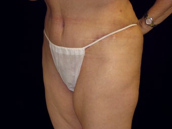 Abdominoplasty