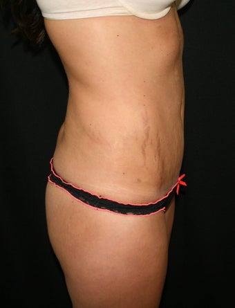 Abdominplasty (mini tummy tuck)