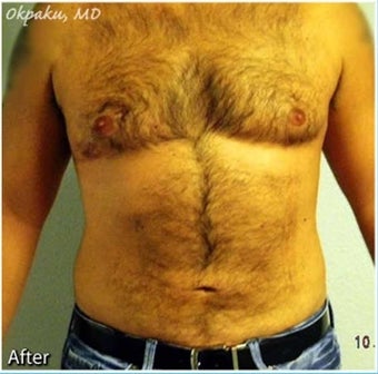 Male Liposuction of Abdomen and flanks