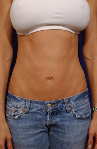 Hybrid abdominoplasty