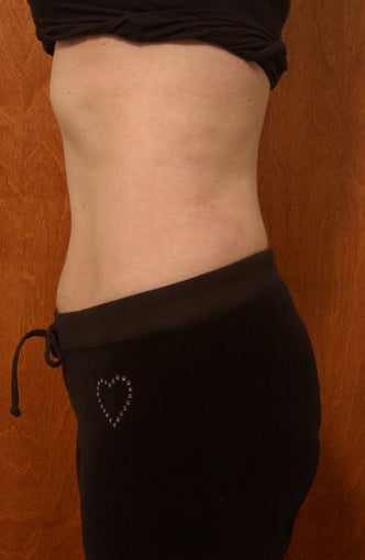 Hybrid abdominoplasty