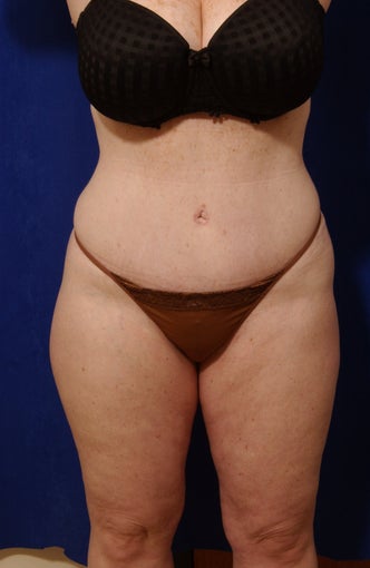 Abdominoplasty