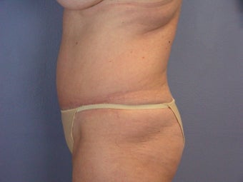 TUMMY TUCK 