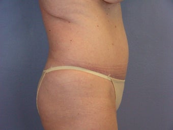 TUMMY TUCK 