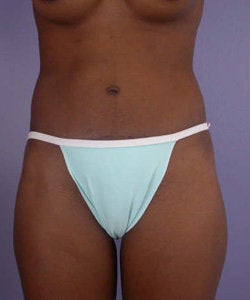 Tummy tuck