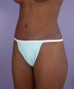 Tummy Tuck