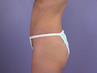 Tummy Tuck