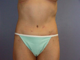 Tummy Tuck