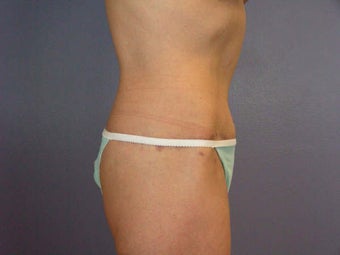 Tummy Tuck