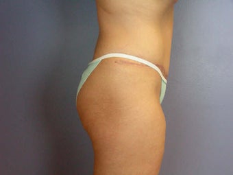 Tummy Tuck