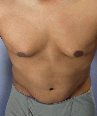 Male Body Contouring