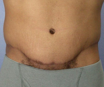 Male Body Contouring