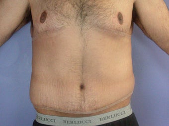 After Weight Loss
