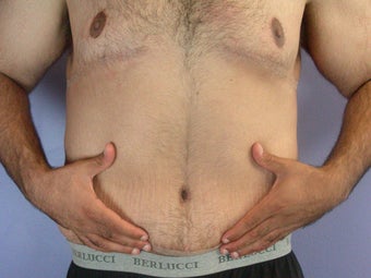 After Weight Loss