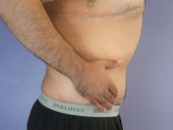 After Weight Loss Male Tummy Tuck