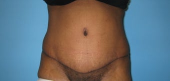tummy tuck