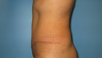 tummy tuck