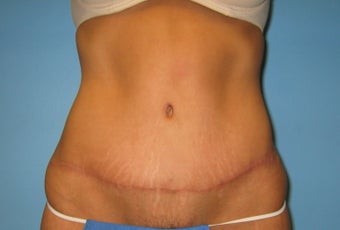 tummy tuck