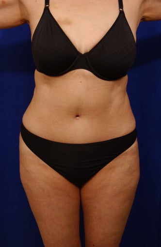 Abdominoplasty with liposculpture of abs, flanks