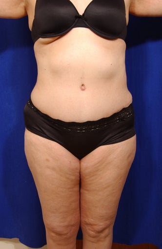 Abdominoplasty with liposculpture of abs, flanks, and waist
