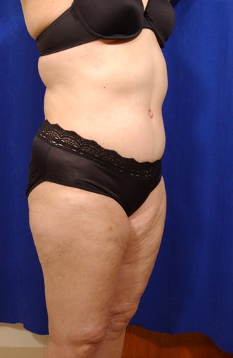 Abdominoplasty with liposculpture of abs, flanks, and waist