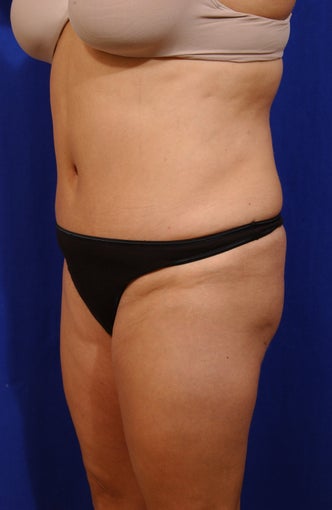 Abdominoplasty with liposculpture of abs, flanks, and waist