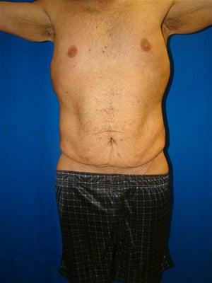 Male Tummy Tuck Surgery (abdominoplasty) Solana Beach, California