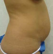 Tummy Tuck 
