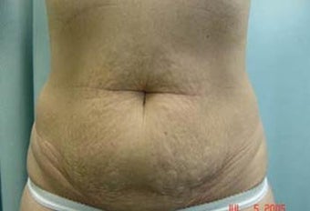 Tummy Tuck