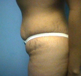 Tummy Tuck