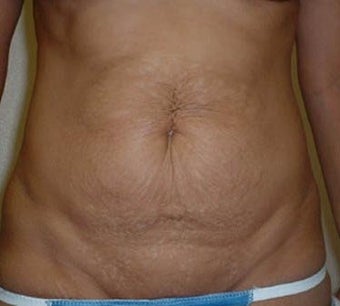 Tummy Tuck